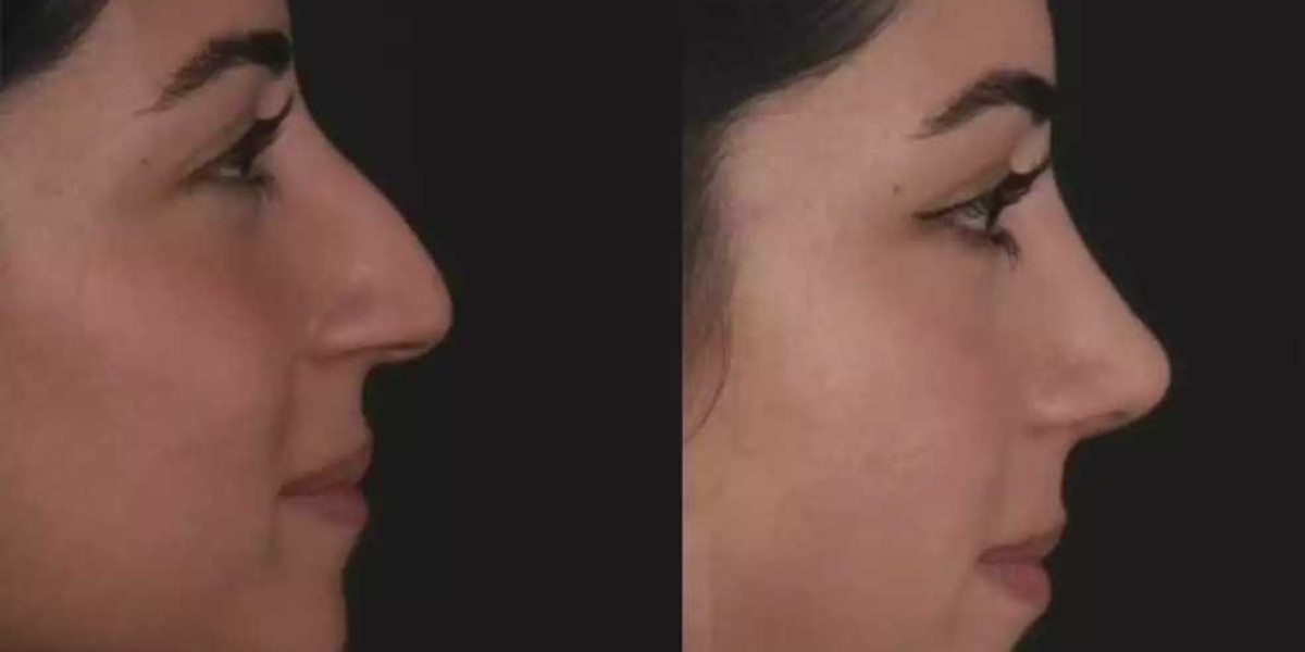 Can Best Doctors in Dubai Improve Septoplasty Safety and Precision?