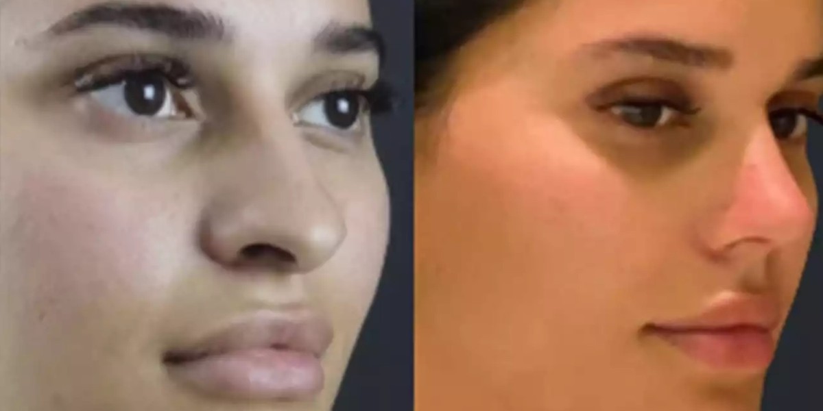 Why Consider Best Doctors in Dubai Before Planning Rhinoplasty?